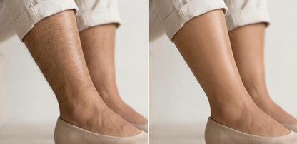 IPL Hair Removal Device