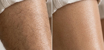 IPL Hair Removal Device