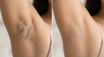 IPL Hair Removal Device